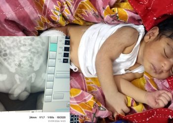 কলাপাড়ায় থেরাপি দেওয়ার কথা বলে নবজাতকের পা ভাঙলেন নার্স