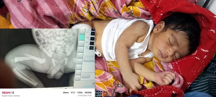কলাপাড়ায় থেরাপি দেওয়ার কথা বলে নবজাতকের পা ভাঙলেন নার্স