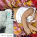 কলাপাড়ায় থেরাপি দেওয়ার কথা বলে নবজাতকের পা ভাঙলেন নার্স